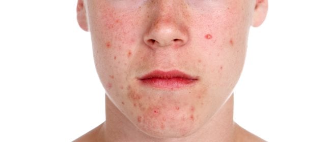 Acne