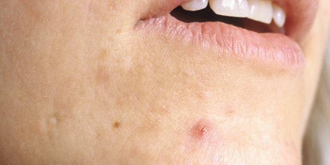 aCNE2