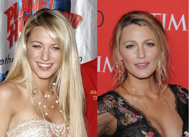 Blake Lively rhinoplastie